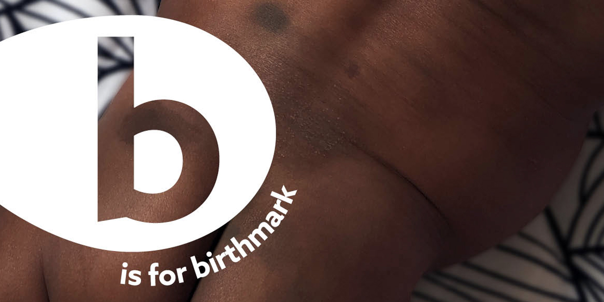 B: Birthmarks (Doğum Lekeleri)